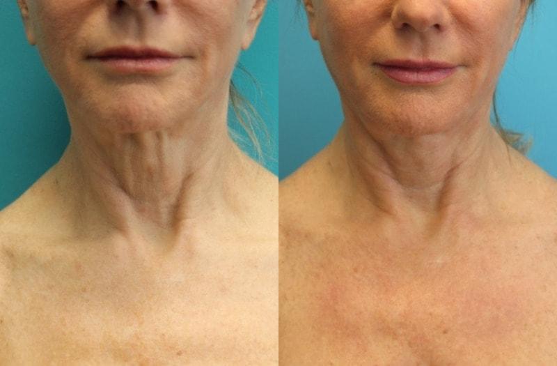 Modern Surgical Arts of Denver neck lift result — Highlands Ranch, CO