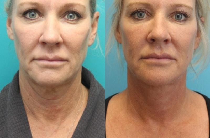Modern Surgical Arts of Denver neck lift result — Highlands Ranch, CO