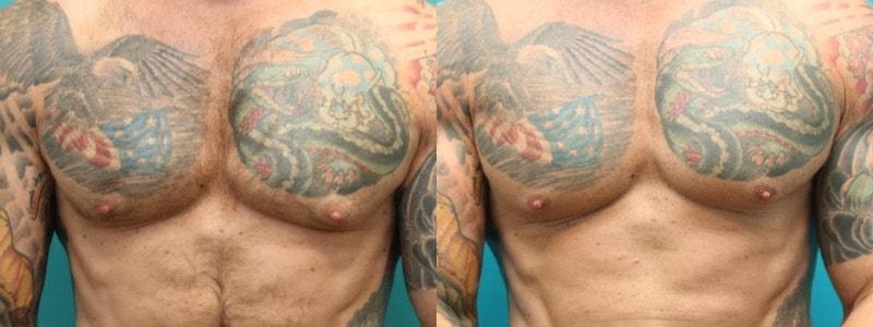 Modern Surgical Arts of Denver gynecomastia result — Highlands Ranch, CO