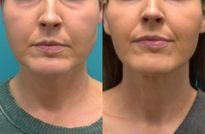Modern Surgical Arts of Denver neck lift result — Highlands Ranch, CO