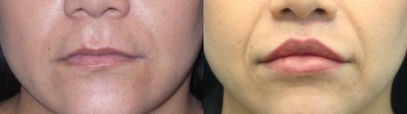 Modern Surgical Arts of Denver lip lift result — Highlands Ranch, CO