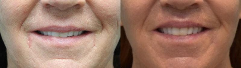 Modern Surgical Arts of Denver lip lift result — Highlands Ranch, CO