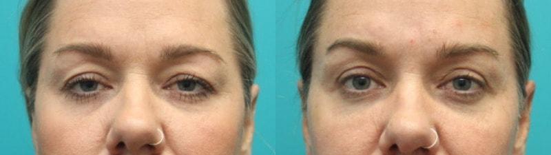 Modern Surgical Arts of Denver brow lift result — Highlands Ranch, CO
