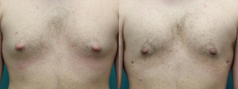 Modern Surgical Arts of Denver gynecomastia result — Highlands Ranch, CO