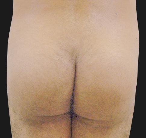 Aristocrat Plastic Surgery: Dr. Kevin Tehrani - NYC bbl after — New York, NY