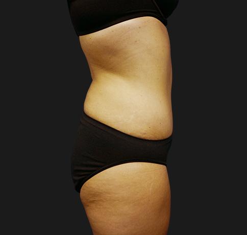 Aristocrat Plastic Surgery: Dr. Kevin Tehrani - NYC liposuction after — New York, NY