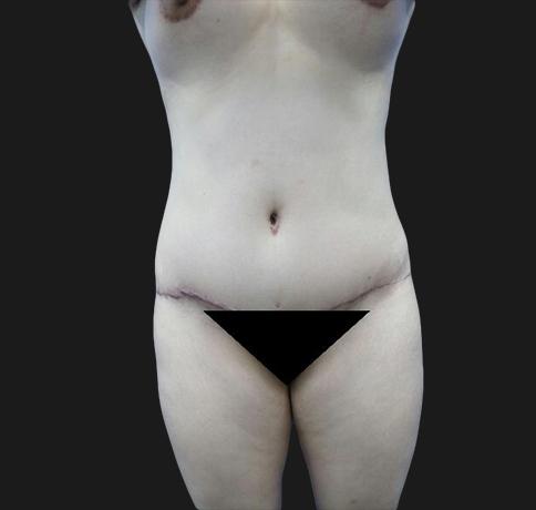 Aristocrat Plastic Surgery: Dr. Kevin Tehrani - NYC tummy tuck after — New York, NY