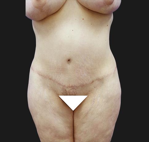 Aristocrat Plastic Surgery: Dr. Kevin Tehrani - NYC tummy tuck after — New York, NY