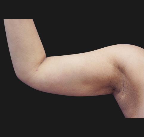 Aristocrat Plastic Surgery: Dr. Kevin Tehrani - NYC liposuction after — New York, NY