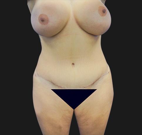 Aristocrat Plastic Surgery: Dr. Kevin Tehrani - NYC liposuction after — New York, NY