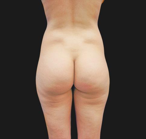Brazilian Butt Lift before at Aristocrat Plastic Surgery: Dr. Kevin Tehrani - NYC in New York, NY