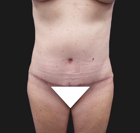 Aristocrat Plastic Surgery: Dr. Kevin Tehrani - NYC tummy tuck after — New York, NY