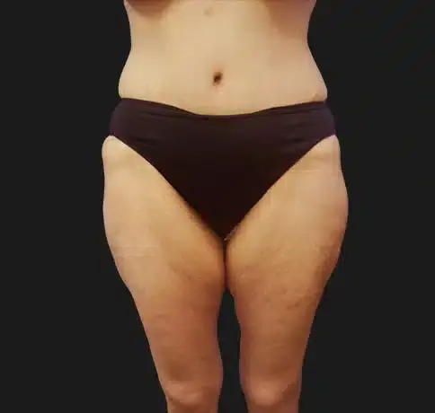 Mommy Makeover after at Aristocrat Plastic Surgery: Dr. Kevin Tehrani - NYC in New York, NY