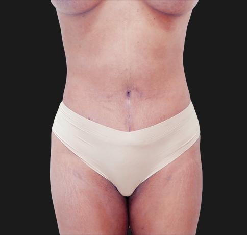 Aristocrat Plastic Surgery: Dr. Kevin Tehrani - NYC tummy tuck after — New York, NY