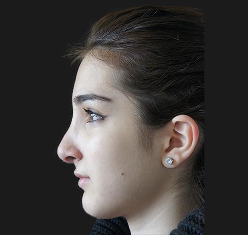 Aristocrat Plastic Surgery: Dr. Kevin Tehrani - NYC rhinoplasty after — New York, NY