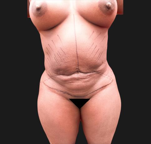 Tummy Tuck before at Aristocrat Plastic Surgery: Dr. Kevin Tehrani - NYC in New York, NY