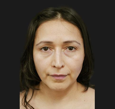 Aristocrat Plastic Surgery: Dr. Kevin Tehrani - NYC rhinoplasty after — New York, NY