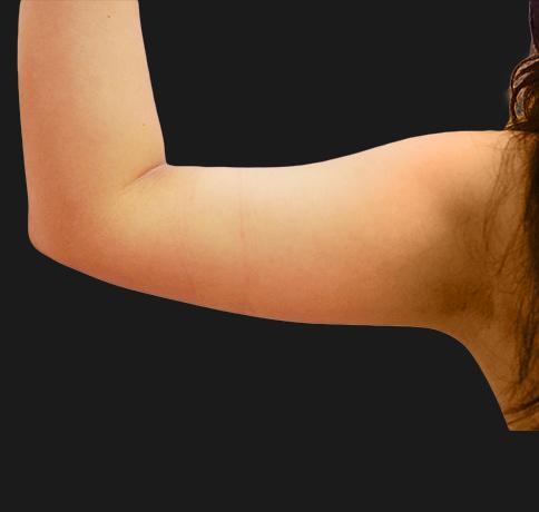 Arm Lift before at Aristocrat Plastic Surgery: Dr. Kevin Tehrani - NYC in New York, NY