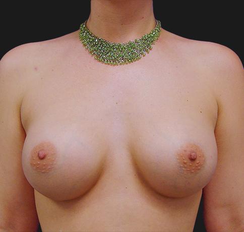 Aristocrat Plastic Surgery: Dr. Kevin Tehrani - NYC breast augmentation after — New York, NY