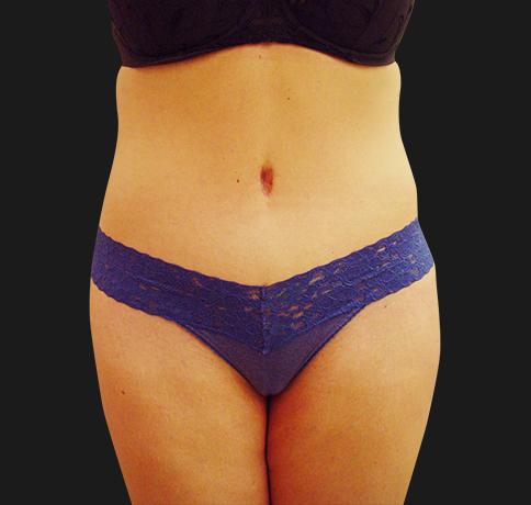 Aristocrat Plastic Surgery: Dr. Kevin Tehrani - NYC liposuction after — New York, NY