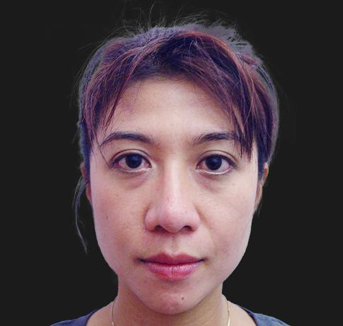Aristocrat Plastic Surgery: Dr. Kevin Tehrani - NYC rhinoplasty after — New York, NY