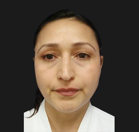 Rhinoplasty before at Aristocrat Plastic Surgery: Dr. Kevin Tehrani - NYC in New York, NY