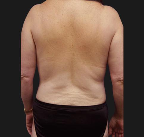 Aristocrat Plastic Surgery: Dr. Kevin Tehrani - NYC coolsculpting after — New York, NY