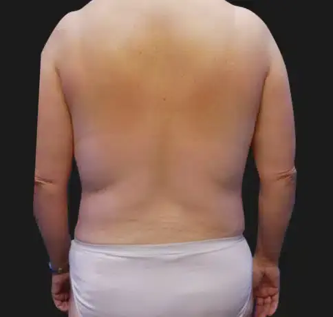 CoolSculpting before at Aristocrat Plastic Surgery: Dr. Kevin Tehrani - NYC in New York, NY