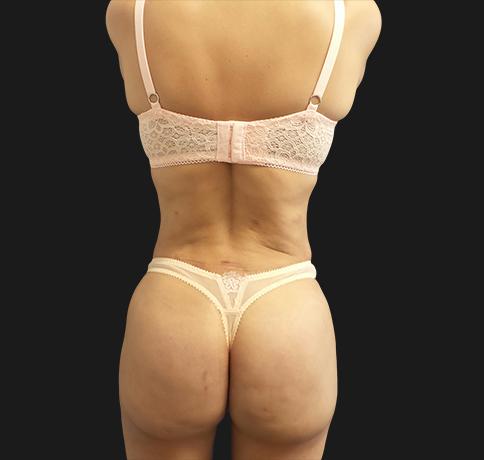 Aristocrat Plastic Surgery: Dr. Kevin Tehrani - NYC bbl after — New York, NY
