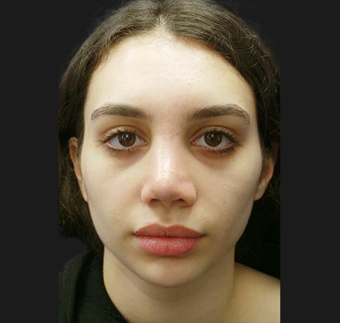 Aristocrat Plastic Surgery: Dr. Kevin Tehrani - NYC rhinoplasty after — New York, NY