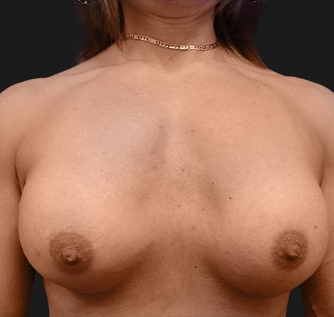 Aristocrat Plastic Surgery: Dr. Kevin Tehrani - NYC breast augmentation after — New York, NY