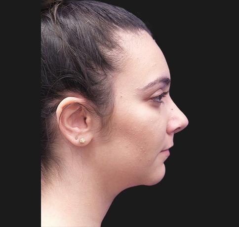 Aristocrat Plastic Surgery: Dr. Kevin Tehrani - NYC rhinoplasty after — New York, NY