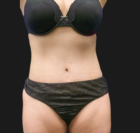 Aristocrat Plastic Surgery: Dr. Kevin Tehrani - NYC liposuction after — New York, NY