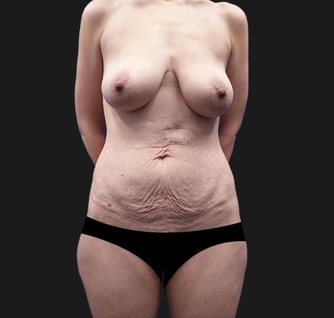 Mommy Makeover before at Aristocrat Plastic Surgery: Dr. Kevin Tehrani - NYC in New York, NY
