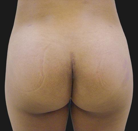 Aristocrat Plastic Surgery: Dr. Kevin Tehrani - NYC bbl after — New York, NY