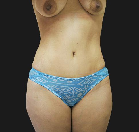 Aristocrat Plastic Surgery: Dr. Kevin Tehrani - NYC liposuction after — New York, NY