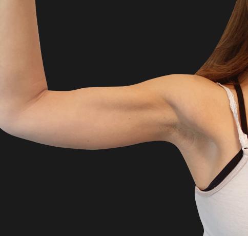 Arm Lift after at Aristocrat Plastic Surgery: Dr. Kevin Tehrani - NYC in New York, NY