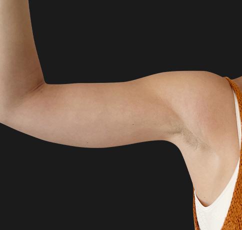 Arm Lift before at Aristocrat Plastic Surgery: Dr. Kevin Tehrani - NYC in New York, NY