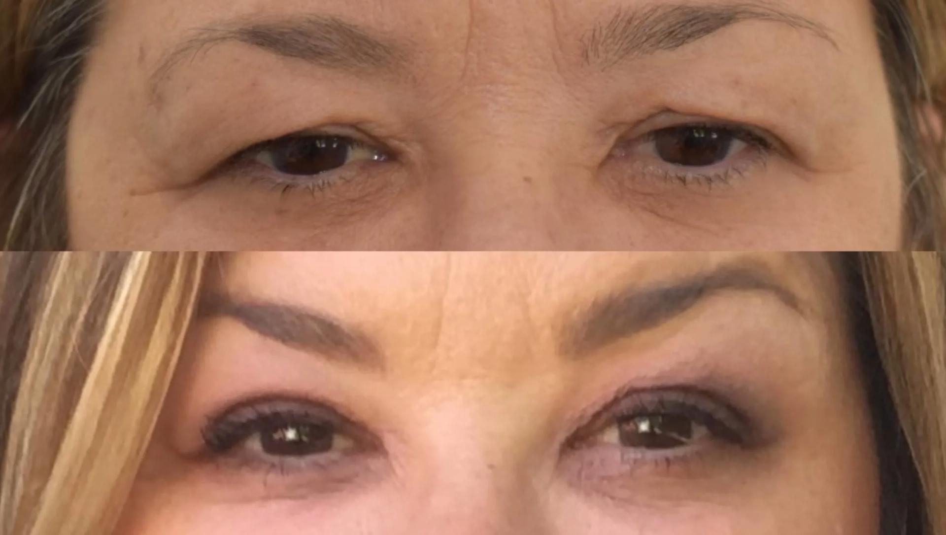 Meaghan Noud, MD eyelid lift result — San Francisco, CA