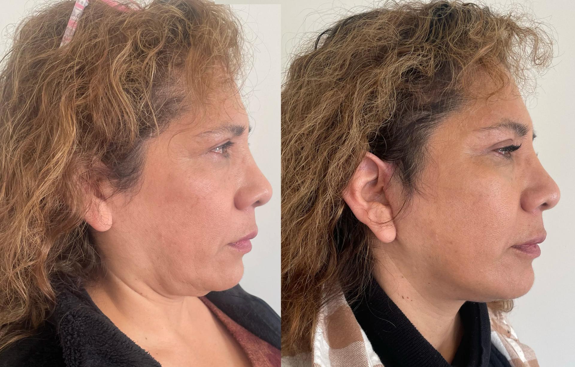 Meaghan Noud, MD facelift result — San Francisco, CA