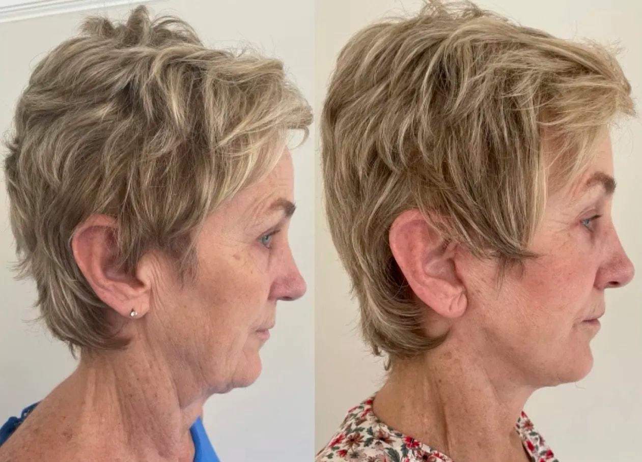 Meaghan Noud, MD facelift result — San Francisco, CA