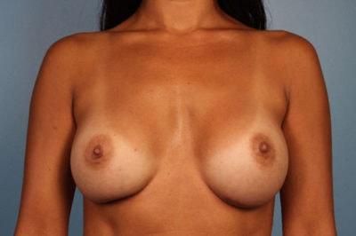 Park Avenue Plastic Surgery breast augmentation after — Winter Park, FL