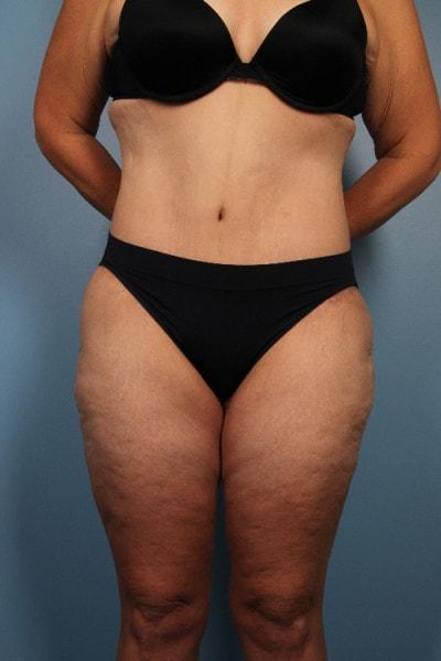 Park Avenue Plastic Surgery tummy tuck after — Winter Park, FL