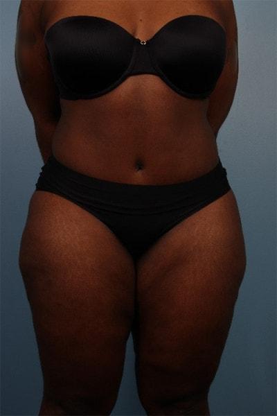 Park Avenue Plastic Surgery tummy tuck after — Winter Park, FL
