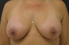 Park Avenue Plastic Surgery breast lift after — Winter Park, FL
