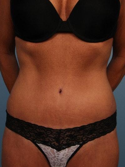 Park Avenue Plastic Surgery tummy tuck after — Winter Park, FL
