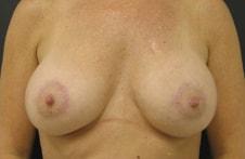 Park Avenue Plastic Surgery breast lift after — Winter Park, FL