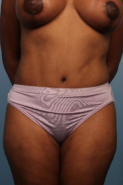 Park Avenue Plastic Surgery tummy tuck after — Winter Park, FL
