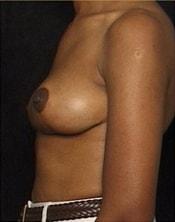 Park Avenue Plastic Surgery breast lift after — Winter Park, FL