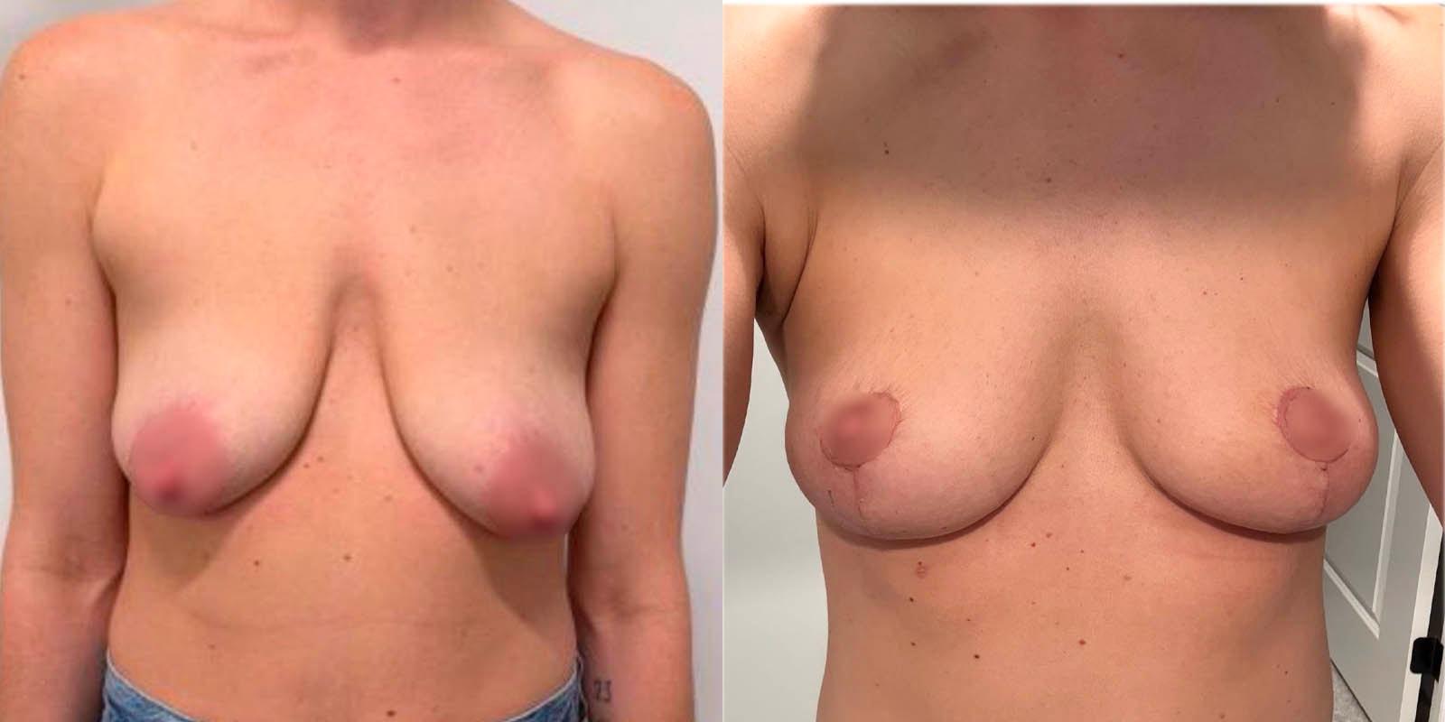 Daniel Mazzaferro, MD breast lift result — New York, NY